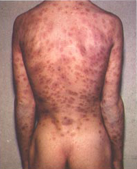 Syphilis lesions on back