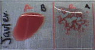 Student blood test. Three drops of blood are mixed with anti-B (left) and anti-A (right) serum. Agglutination with anti-A suggests this individual is type A.