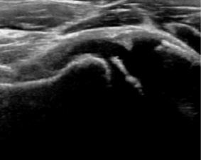Flattening of the femoral head in a patient with Perthes disease.