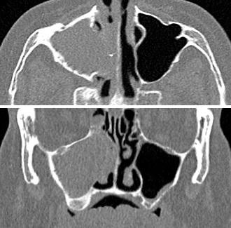 CT scan of chronic sinusitis, showing a filled right maxillary sinus with sclerotic thickened bone