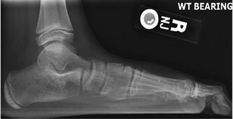 Lateral X-ray of a flat foot with C-sign, which is a bony bridge between the talar dome and sustentaculum tali, in combination with a prominent inferior border of the sustentaculum tali. This represents a talocalcaneal coalition, which is an abnormal connection between the talus and calcaneus, and is thought to cause the flat foot deformity in this case.