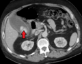 Acute cholecystitis with gallbladder wall thickening, a large gallstone, and a large gallbladder