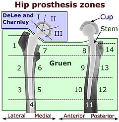 Hip prosthesis zones.