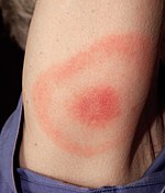 20% of Lyme rashes in the United States show a "bull's eye" or "target-like" appearance.[28][29][30]