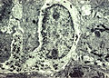 Melanocyte with melanin granules in dendrite. PMID 6200593