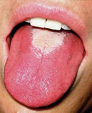 Scarlet fever is an infectious illness common among children between four and eight. It was once a major cause of death, but now can be treated with antibiotics. One symptom is a scarlet-colored tongue.