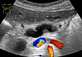 Ultrasonography of a dilated pancreatic duct (in this case 9mm) due to pancreatic cancer.