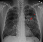 An X-ray showing a tumor in the lung