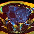 MRI image with multiple uterine leiomyomas