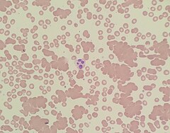 A photomicrograph of a blood smear showing red blood cells in clumps