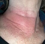 Erythema migrans ("migrating redness") on a woman's neck.[31] Rashes from non-Lyme causes may look similar.[32][33]