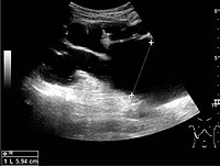 Figure 15. End-stage hydronephrosis with cortical thinning. Measurement of pelvic dilatation on the US image is illustrated by ‘+’ and a dashed line.[1]