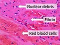 Composition of a fresh thrombus at microscopy, showing nuclear debris in a background of fibrin and red blood cells.