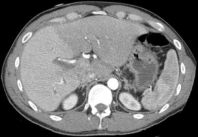 Phase contrast CT image. Contrast is perfusing the right liver but not the left due to a left portal vein thrombus.