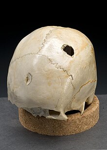 This image shows a hole in the skull of an individual resulting from blunt force trauma.