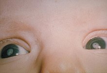 Close up showing the eyes of an infant with opaque lenses.