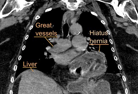 A hiatal hernia as seen on CT