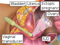 Transvaginal ultrasonography of an ectopic pregnancy, showing the field of view in the following image