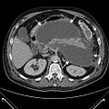 Pancreaspseudocyste im Querschnitt (CT)