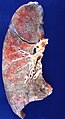 Human lung with radiation pneumonitis.