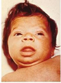 Close up of face, showing myxedematous facies, macroglossia, and skin mottling