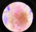 Malignant melanoma, left mid-back marked for biopsy, through dermatoscope