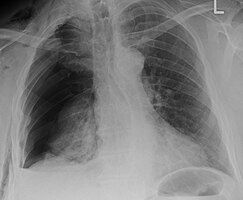 Right sided pneumothorax and rib fractures