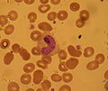 Band neutrophil in peripheral blood film
