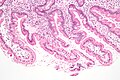 Micrograph showing giardiasis on a duodenal biopsy (H&E stain)