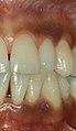 Smoker's melanosis in upper and lower gums