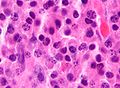 Micrograph of a plasmacytoma, H&E stain