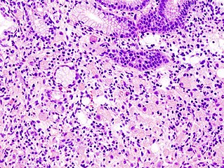 Gastric signet ring cell carcinoma. H&E stain.