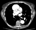 CT with contrast demonstrating aneurysmal dilation and a dissection of the ascending aorta (type A Stanford)