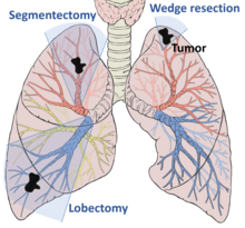 A lung showing a small tumor. Increasingly large pieces are removed for wedge resection, segmentectomy, and lobectomy respectively