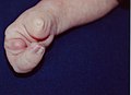 Rechte Hand eines einen Monat alten Kindes mit Ektrodaktylie