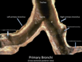 Anatomical dissection of trachea and main bronchi showing the carina