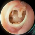 A subtotal perforation of the right tympanic membrane resulting from a previous severe otitis media