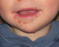 Lesions, Hand, foot and mouth disease on a child.