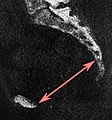 Low-dose CT scan of sagittal pelvic outlet diameter as part of pelvimetry