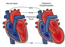 Illustration of a normal heart compared with one with peripartum cardiomyopathy