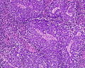 Anaplastic (microcellular, oat cell) carcinoma from the lung (histopathology)