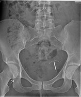X-ray of abdomen with perforated intrauterine device