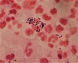 Gram-stain of Gram-positive streptococci surrounded by pus cells from and infected cut on a finger