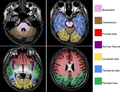 Brain regions on T1 MRI