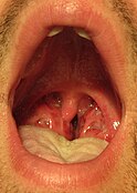 Mouth wide open showing the throat A throat infection which on culture tested positive for group A streptococcus. Note the large tonsils with white exudate.