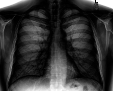 Chest X-ray PA inverted and enhanced.