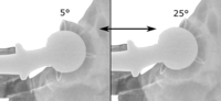 Range of acetabular anteversion