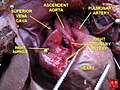 Fetal heart - right coronary artery