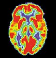 PET scan of a healthy brain - Image courtesy of US National Institute on Aging Alzheimer's Disease Education and Referral Center