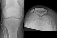 Osteochondral fracture of patella